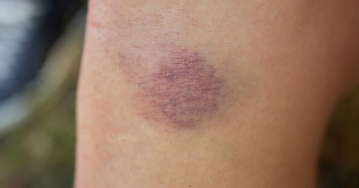 Врач Мезера рассказала о характерных признаках рака крови Доктор 24